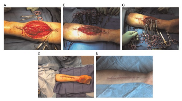 4. allgower-donati 垂直褥式缝合法缝合大张力创面