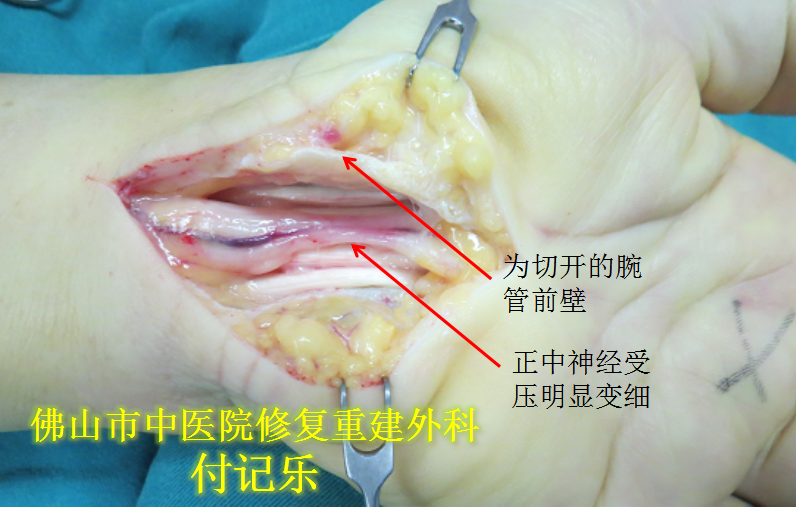 腕管综合征的诊断及手术治疗