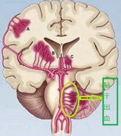 另外脑干中有维持我们清醒的脑干上行激活系统和心血管和呼吸的中枢