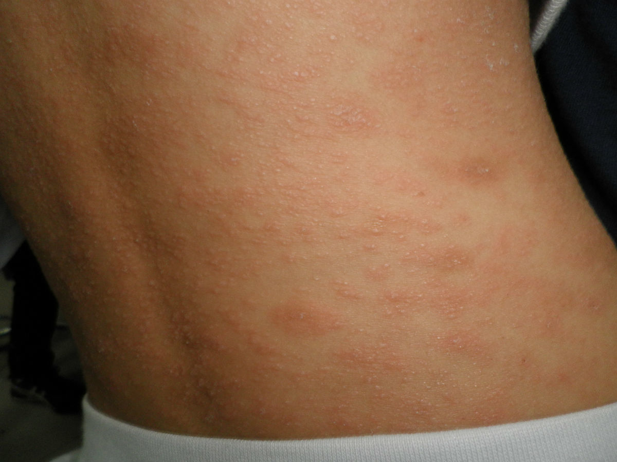 二期梅毒疹照片图片