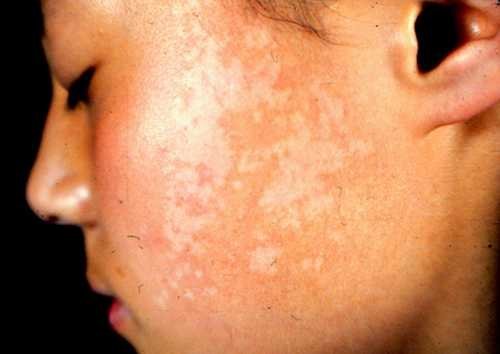 (2 )无色素性痣:为局限性皮肤浅色斑,任何种族,男女均可发生.