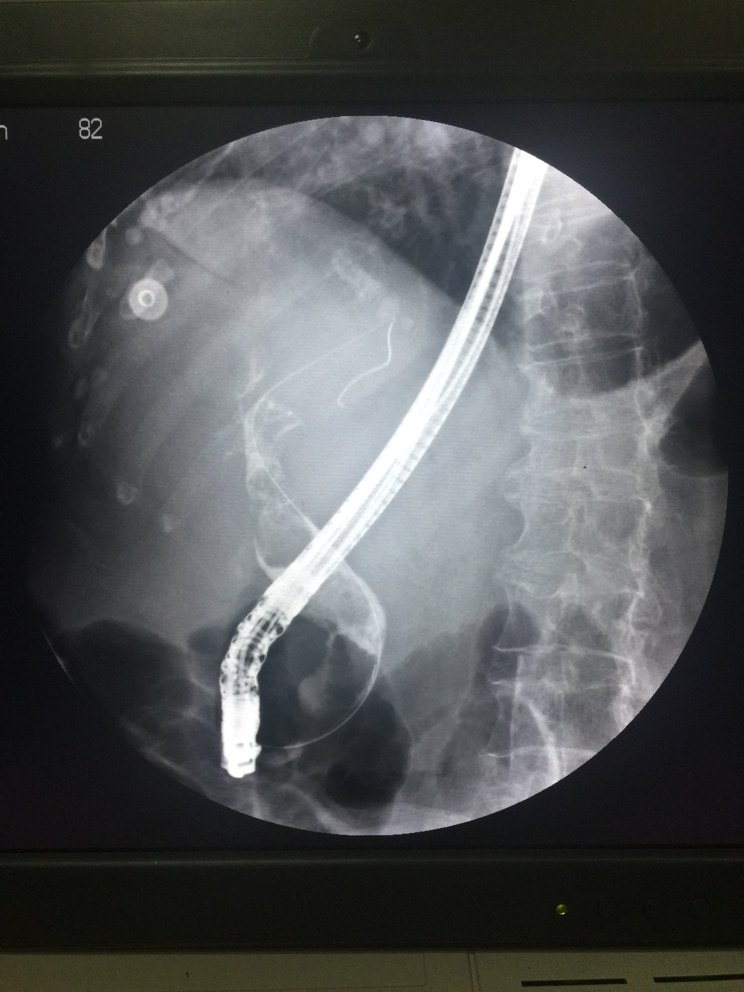 胆管大石头微创取出(2cm胆管色素软结石ercp取出) - 好大夫在线