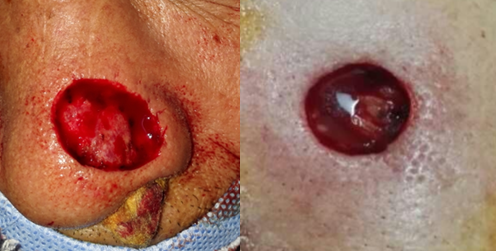 基底细胞癌的手术治疗 - 好大夫在线