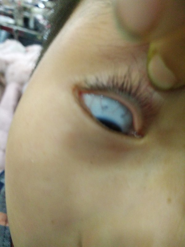 4岁宝宝白眼球有黑斑图片