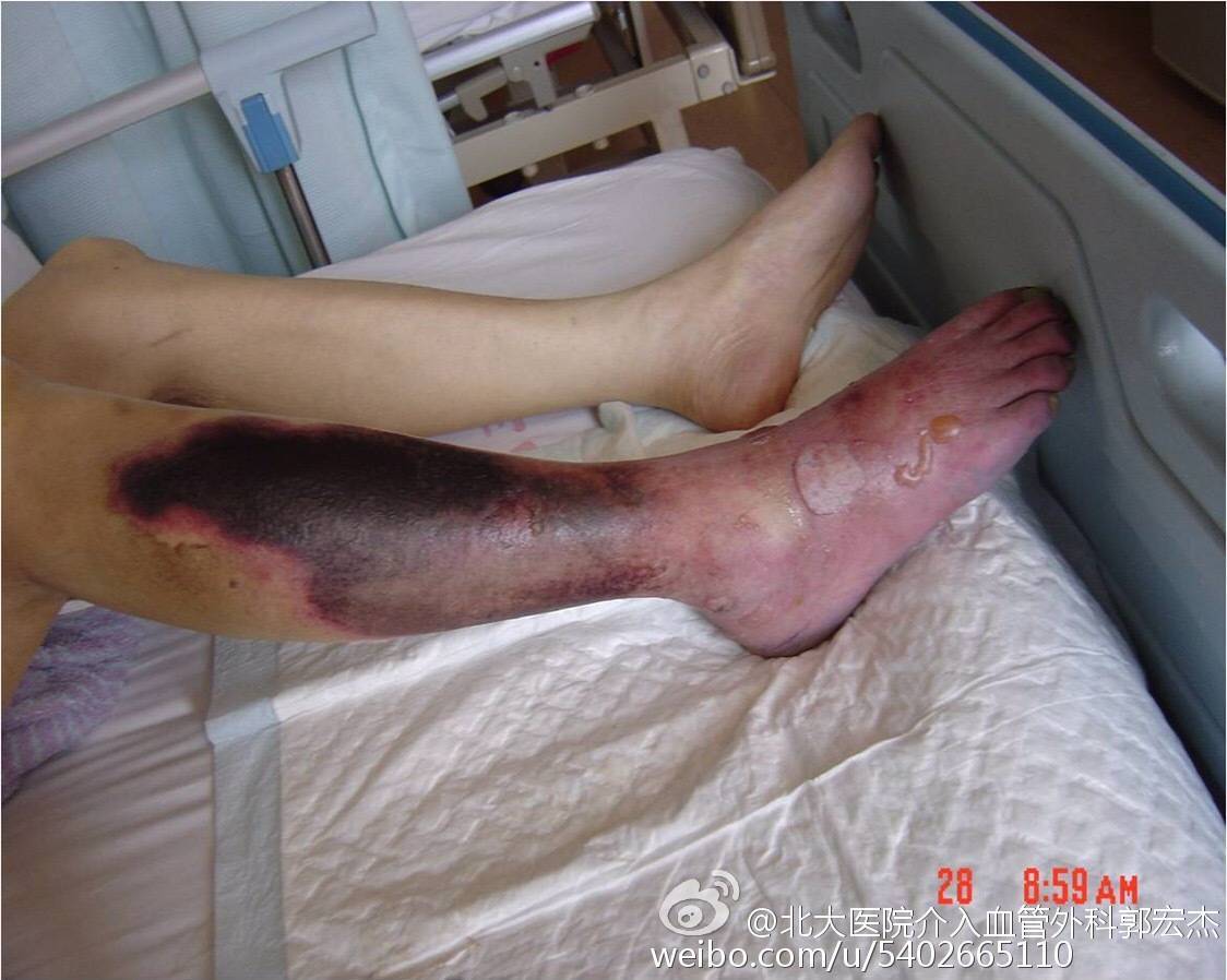哪些腿疼会要命下肢动脉栓塞