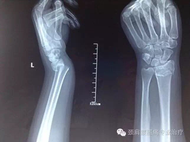 colles骨折 - 好大夫在线