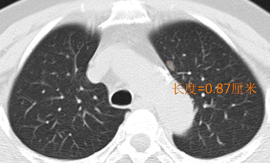 肺磨玻璃结节是肺癌吗--遇到肺磨玻璃结节莫惊
