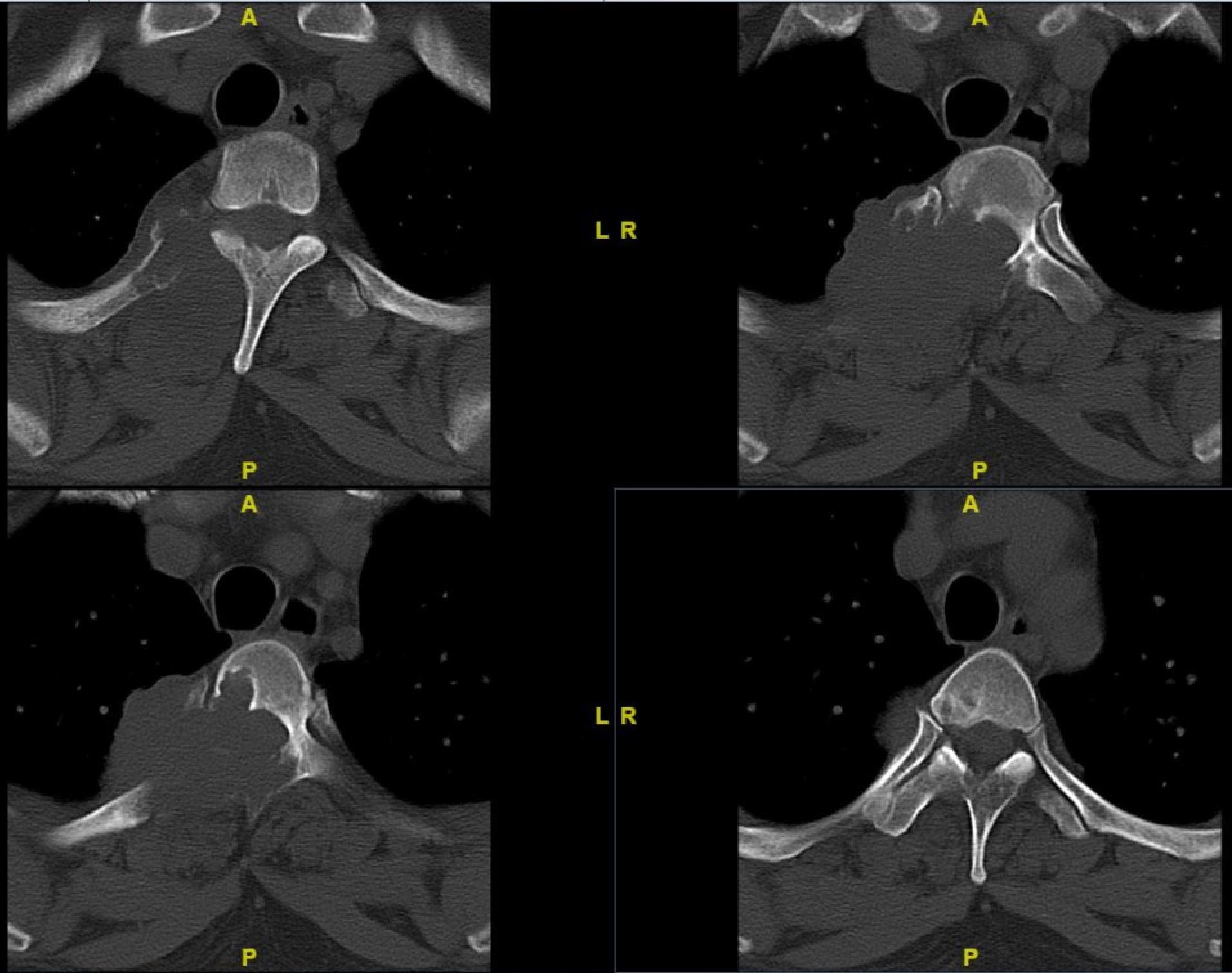 胸椎骨巨细胞瘤手术治疗 - 好大夫在线