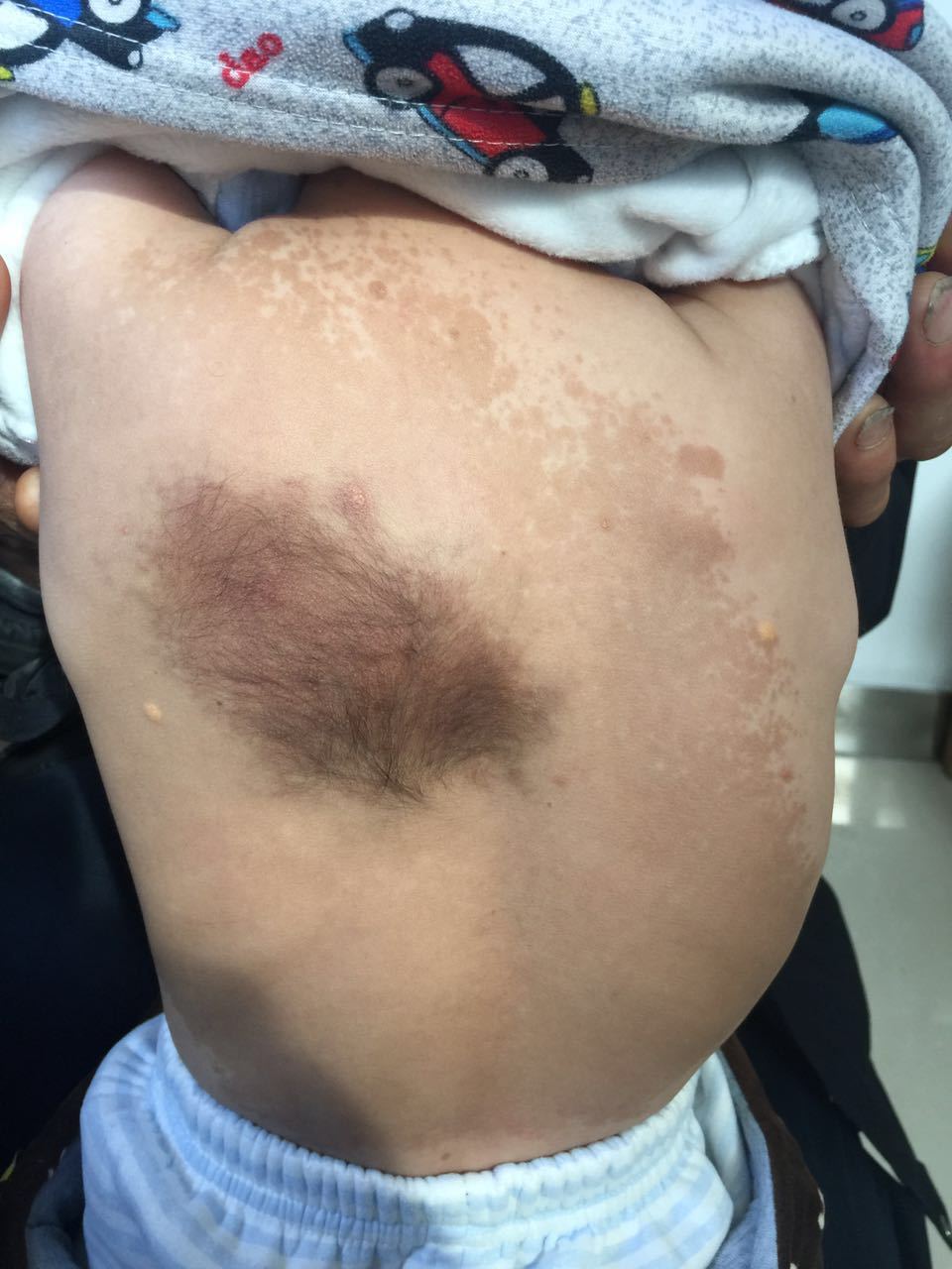 nf-1型婴幼儿早发性脊柱侧弯(2岁),apex=t9-10