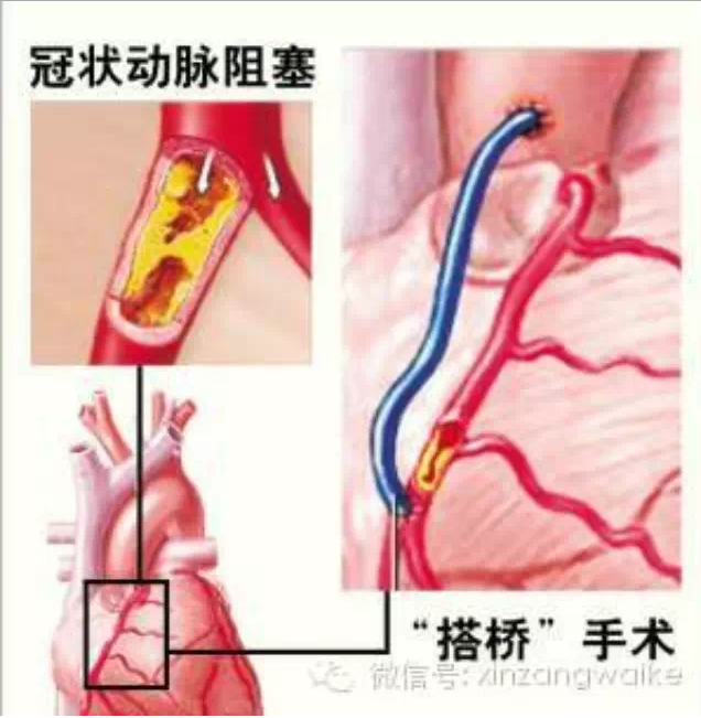 心脏搭桥和支架的区别