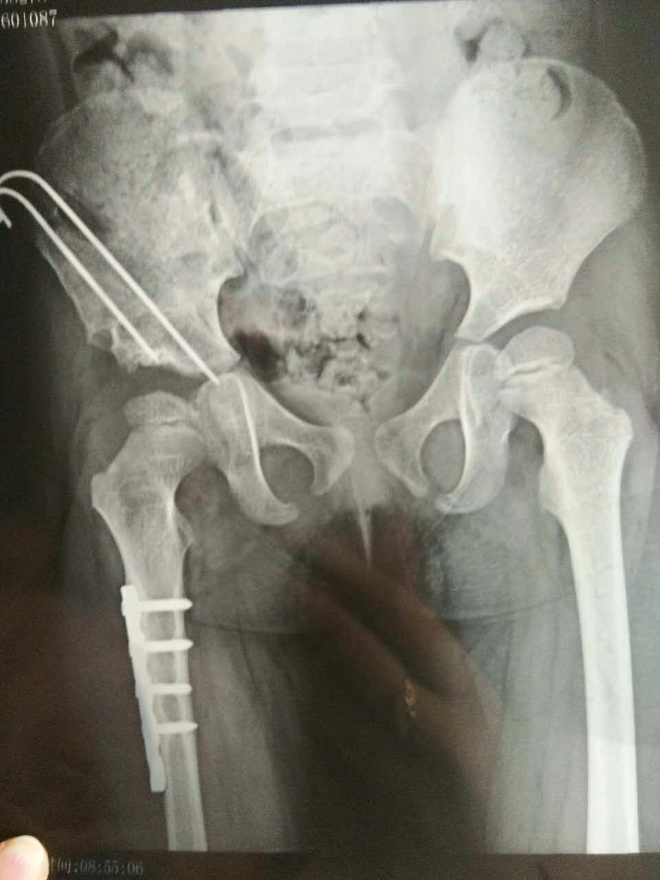 病例分亨,髋关节脱位