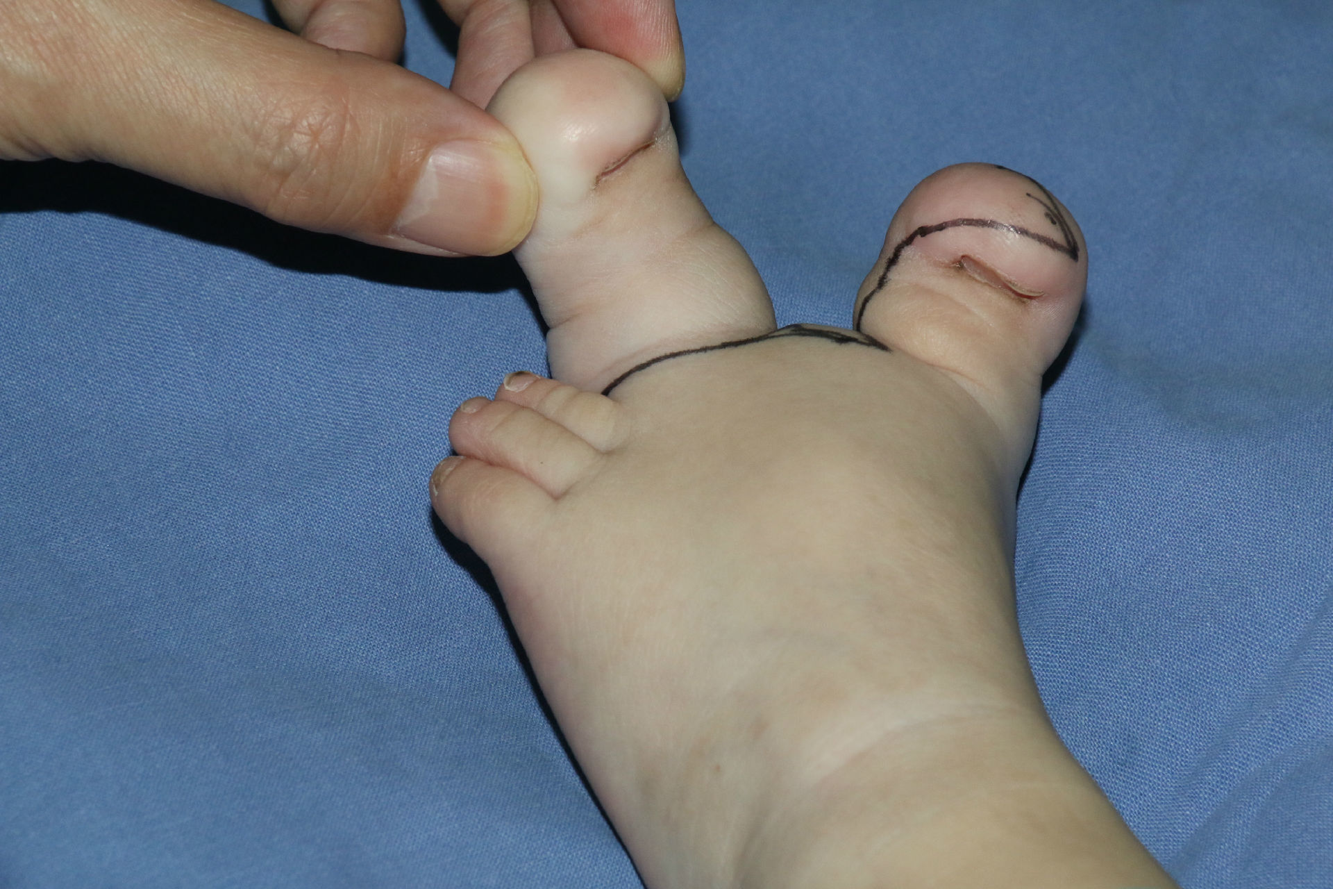 孩子的脚趾头长的比另一个大如何做手术效果如何 