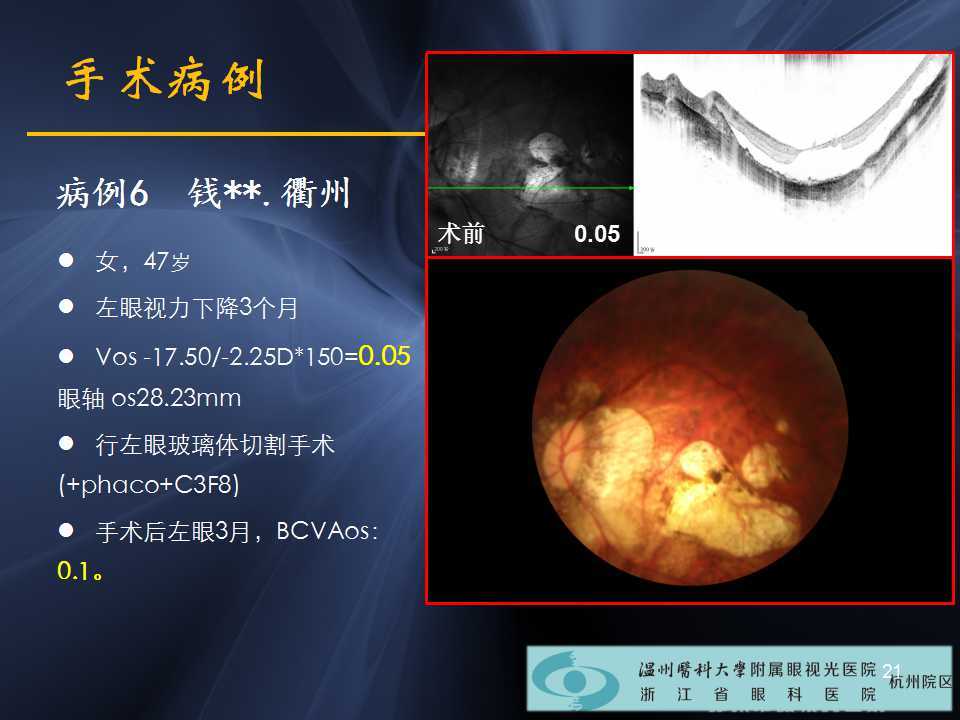 高度近視黃斑劈裂_近視_疾病介紹_病因_症狀_遺傳_手術_治療方法_介紹