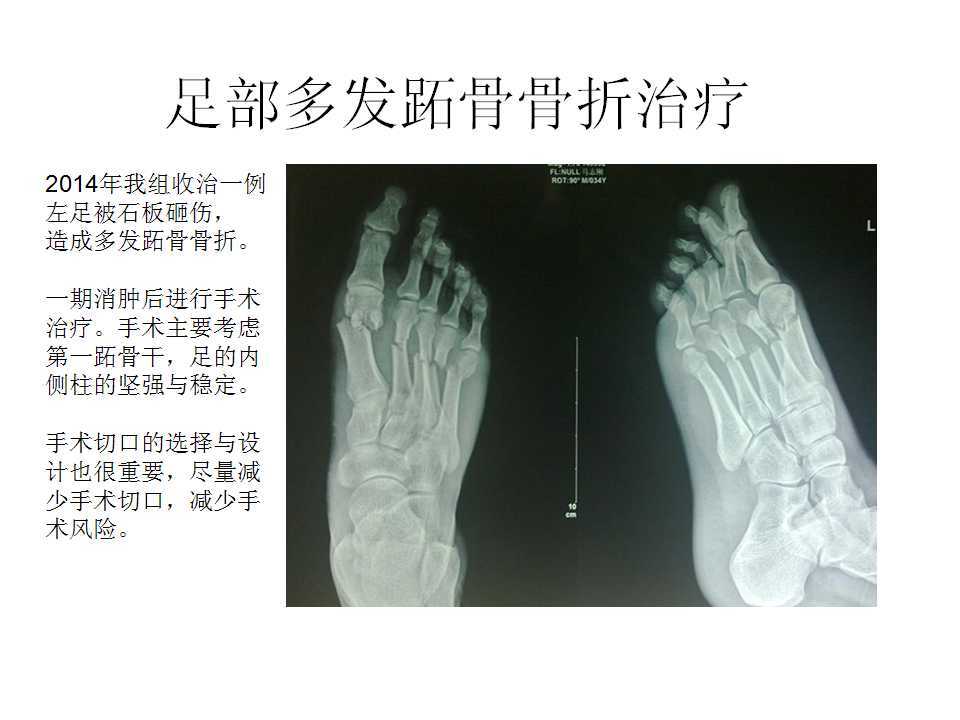 多发足部跖骨骨折手术治疗梁志军
