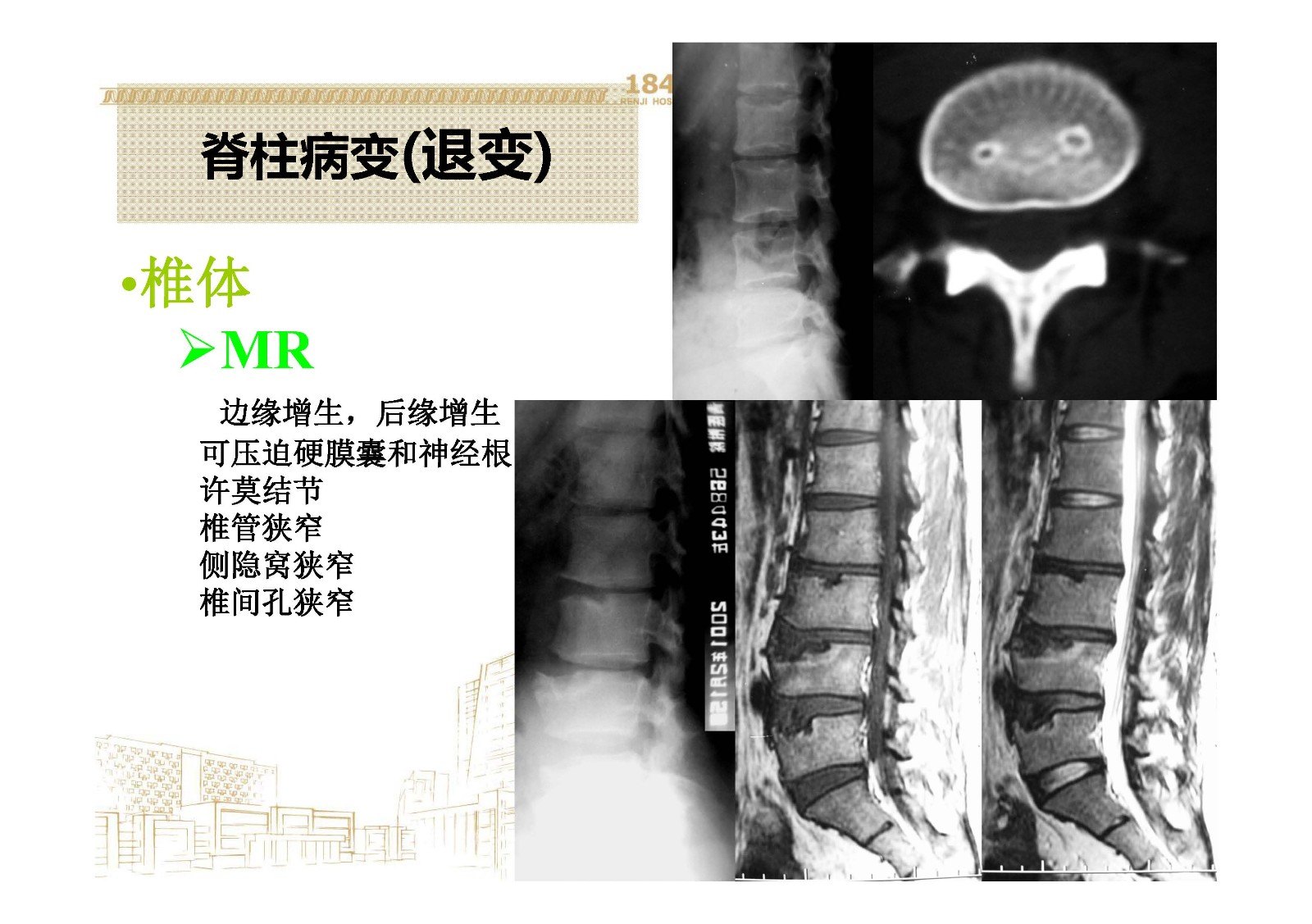 脊柱骨关节退行性变极为常见,尤其是在活动度较大的下颈段,下胸段和腰