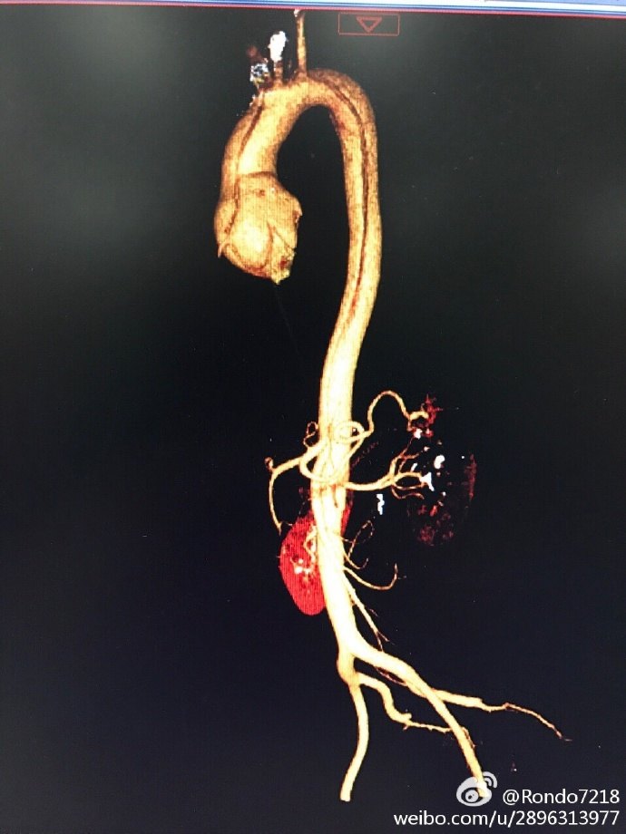 david全弓支架象鼻