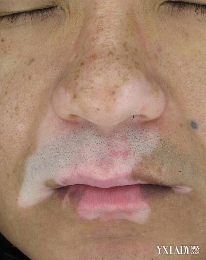嘴唇出现白癜风 - 好大夫在线