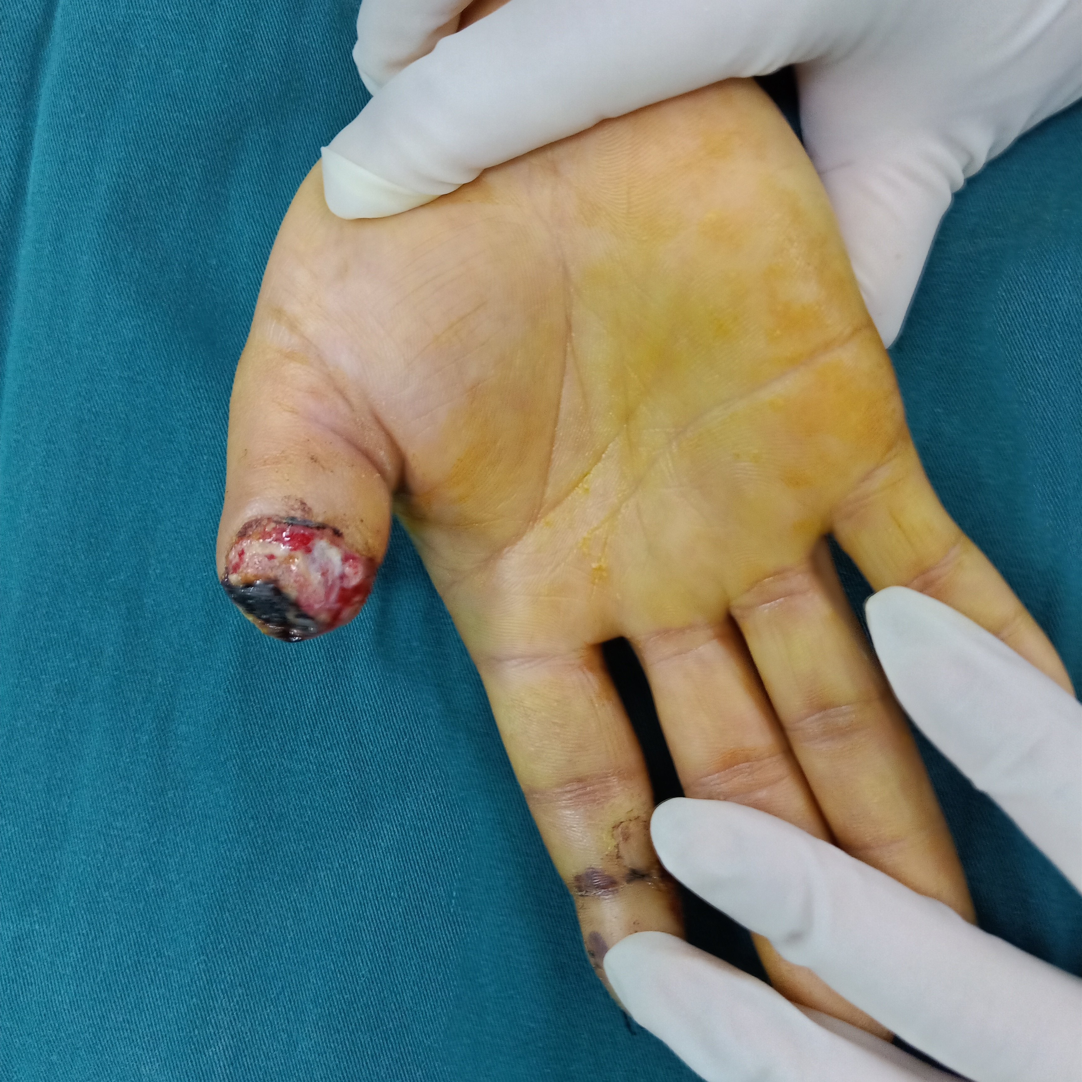 右手大拇指9级工伤图图片