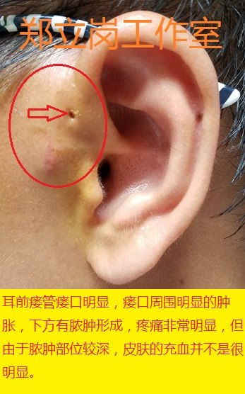 郑立岗感染期耳前瘘管切除术第79广东佛山南海