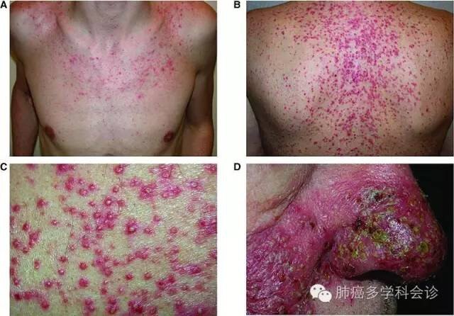 现身说法:教你如何控制靶向药物的皮疹和瘙痒 - 好大夫在线