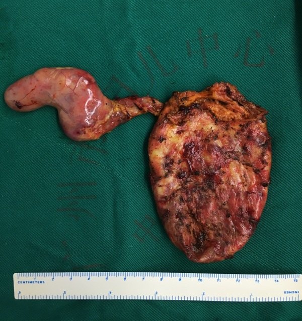 3d腹腔镜下胆总管囊肿先天性胆总管扩张症根治术的科普