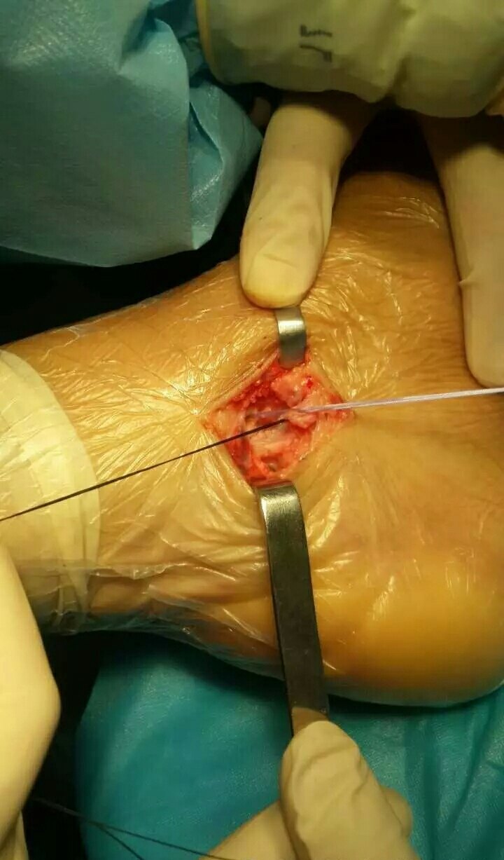 足内侧痛一副舟骨