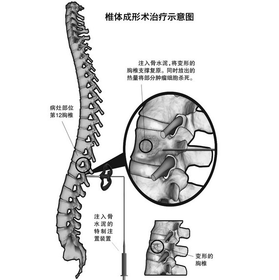 3,經皮椎體(後凸)成形術術後注意事項