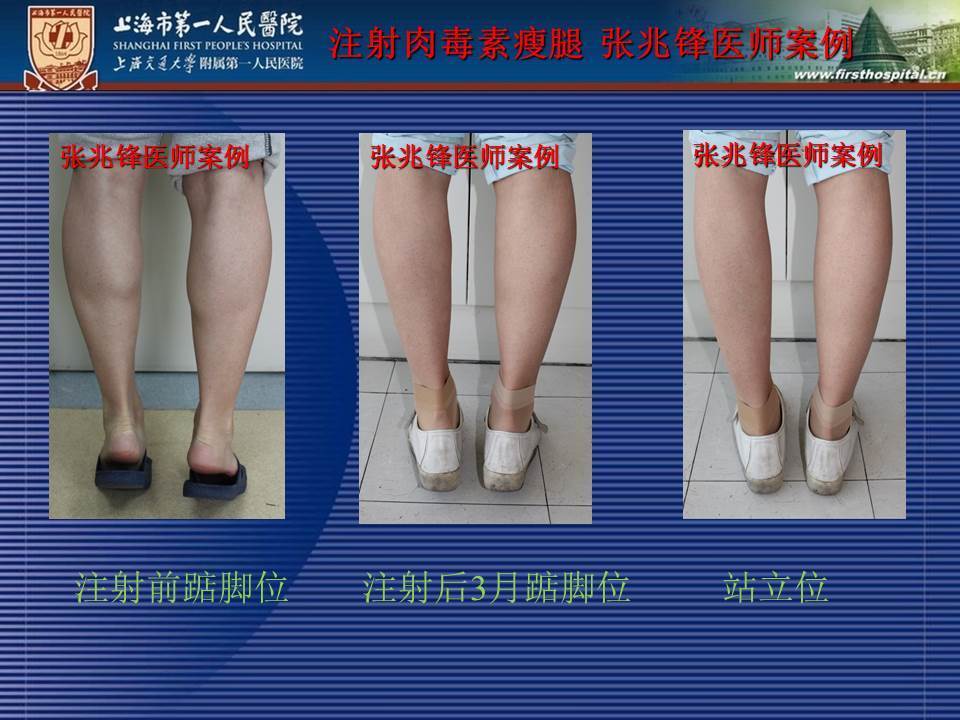 肉毒素注射瘦小腿 - 好大夫在线