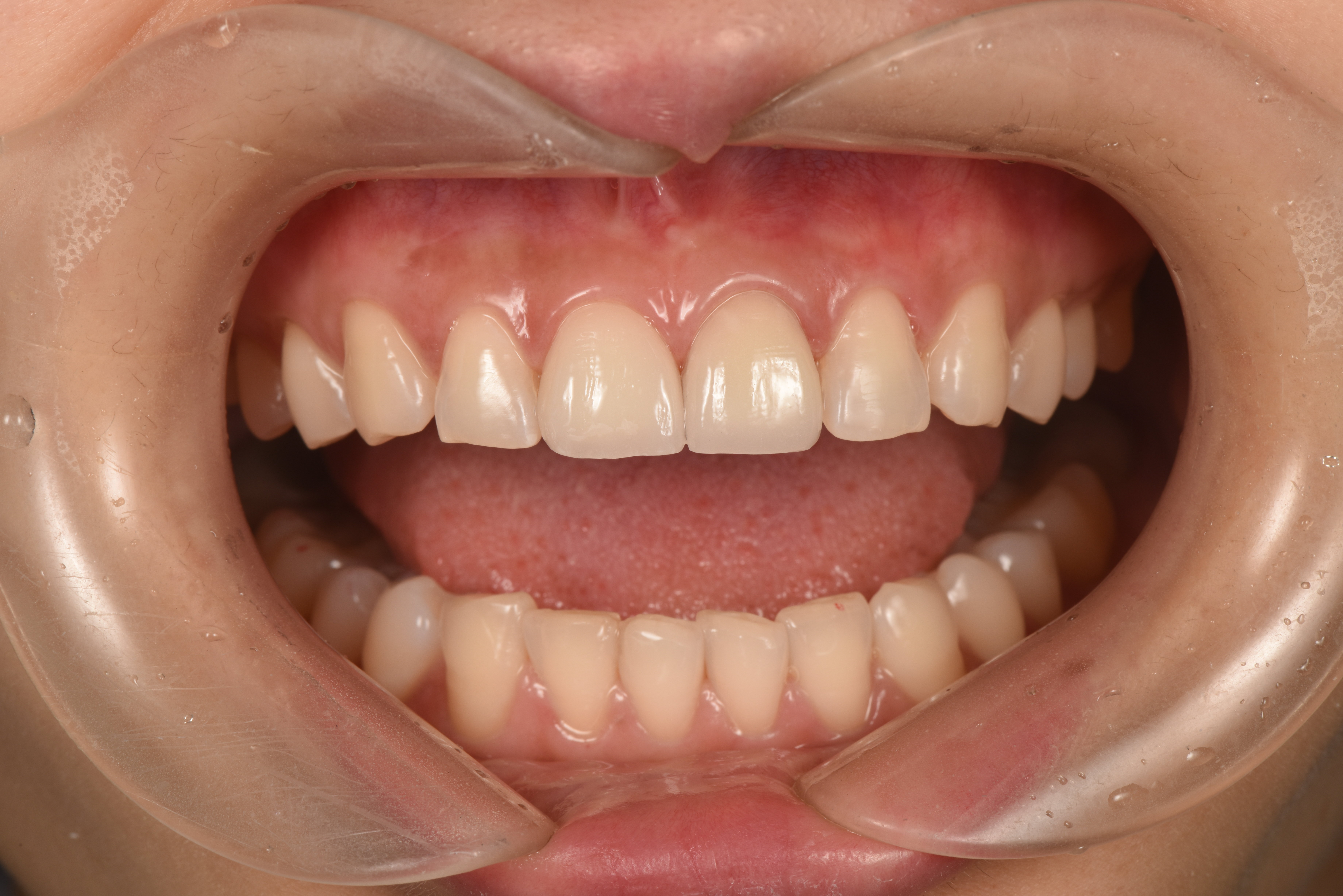 瓷贴面修复变色前牙 - 好大夫在线