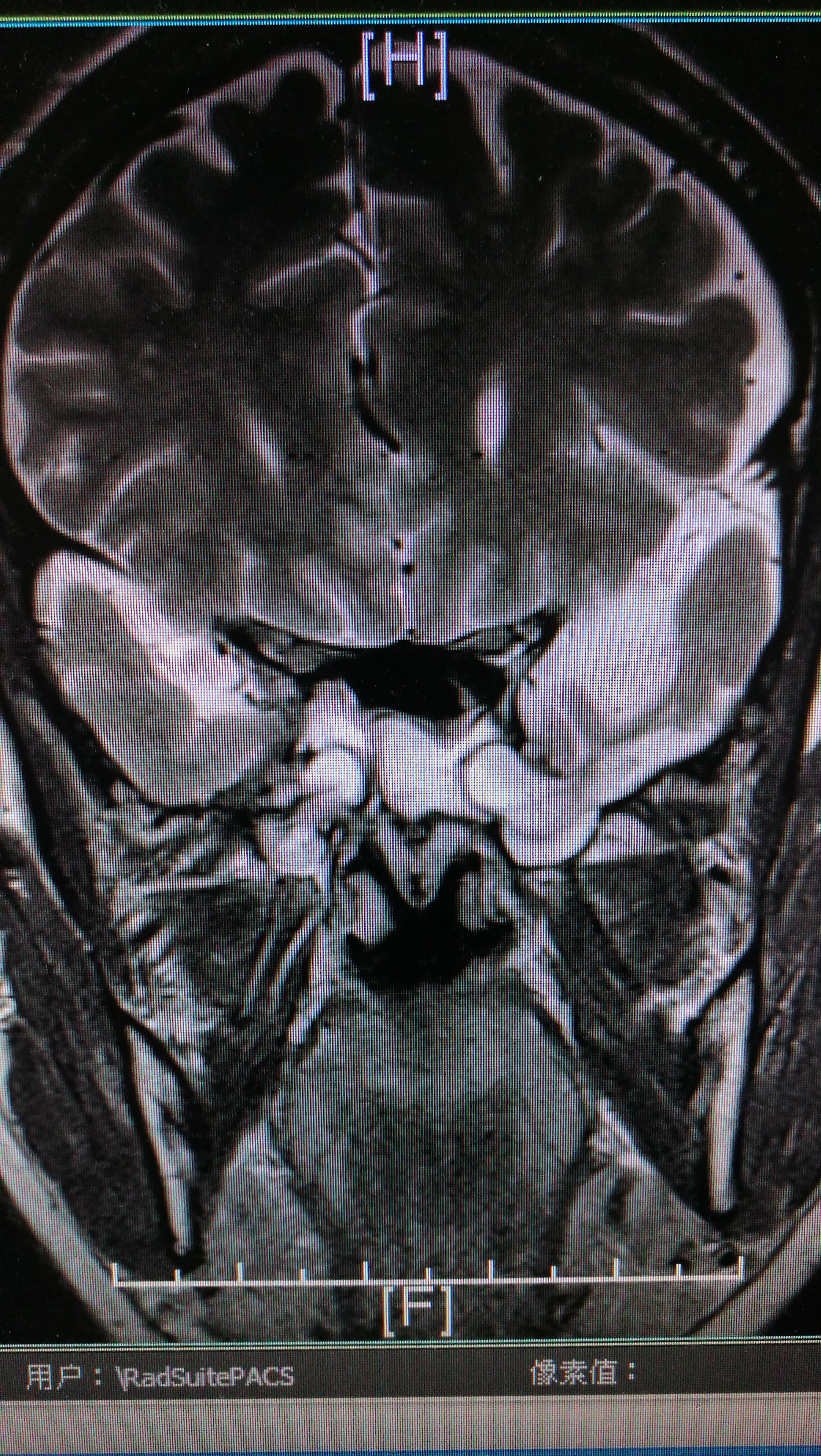 图一,术前mri显示左侧中颅窝底部脑膜脑膨出,脑脊液鼻漏.
