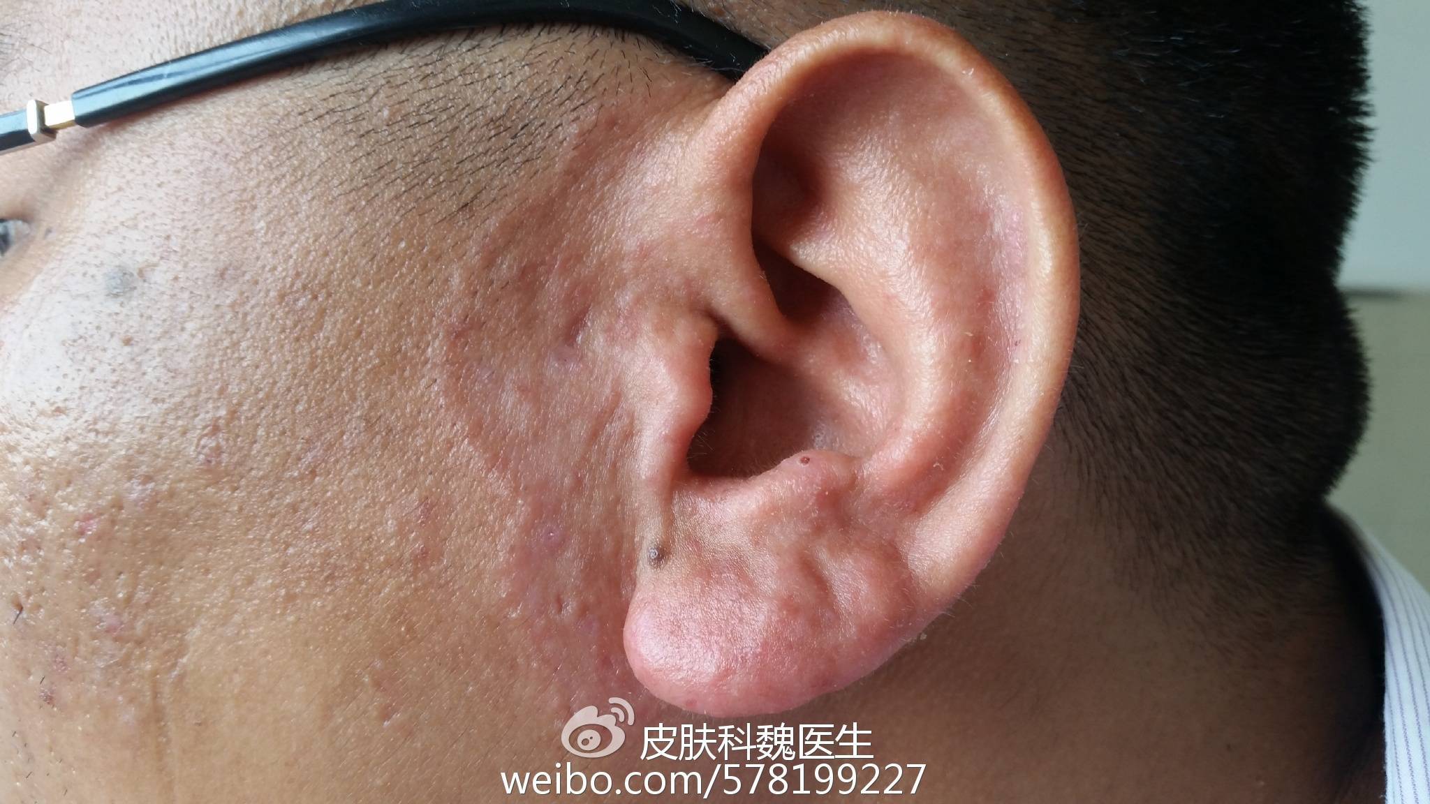 体癣股癣花斑糠疹头癣甲癣真菌性肉芽肿着色芽生菌病镜下的真菌如何