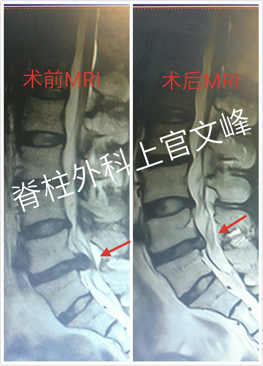 脊柱内镜经椎板间入路治愈腰5骶1椎间盘突出症病例分享