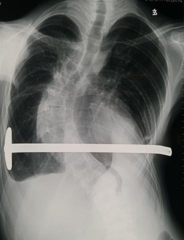ct提示胸廓复合型畸形,胸骨下端凹陷,左侧前胸壁前突,心脏位于左侧