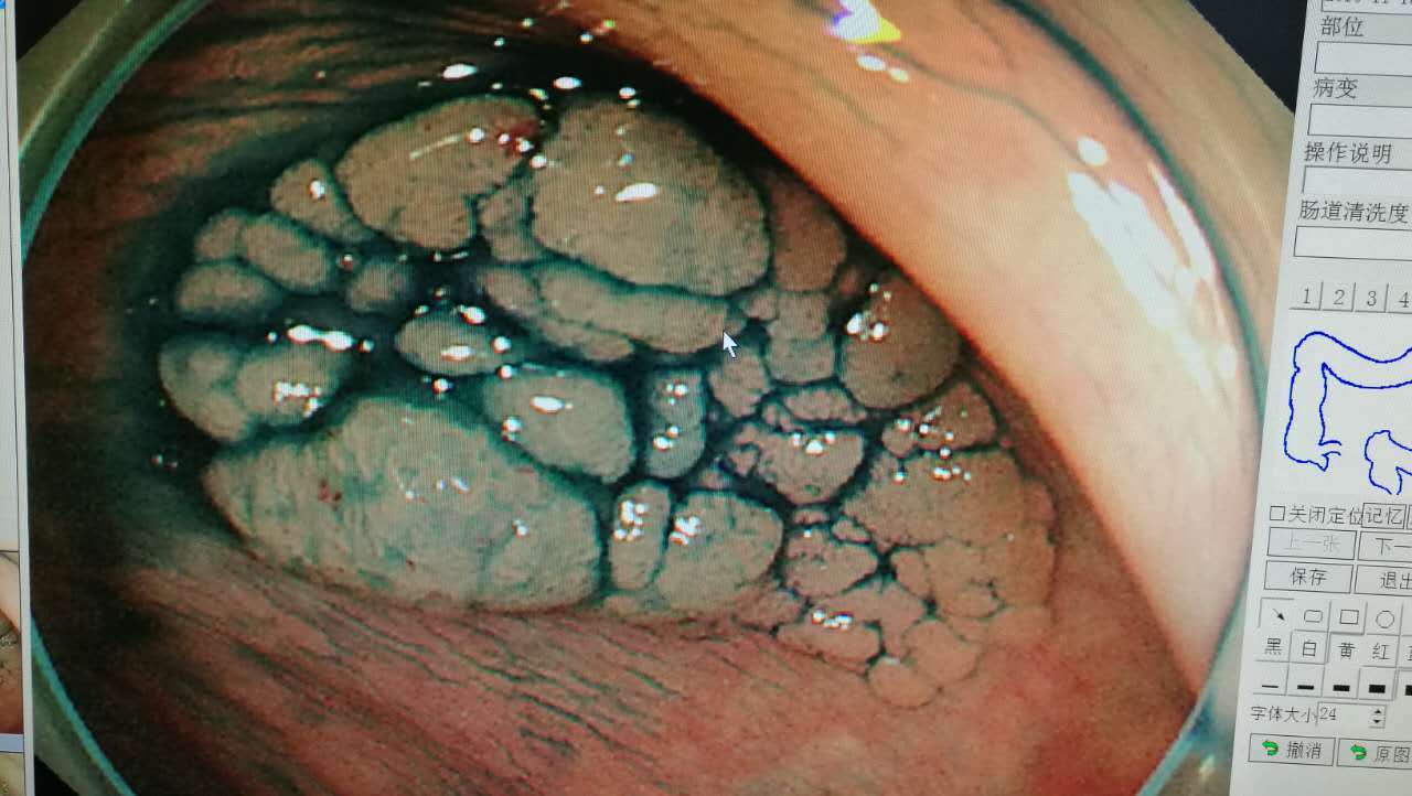 肠镜下肠癌图片