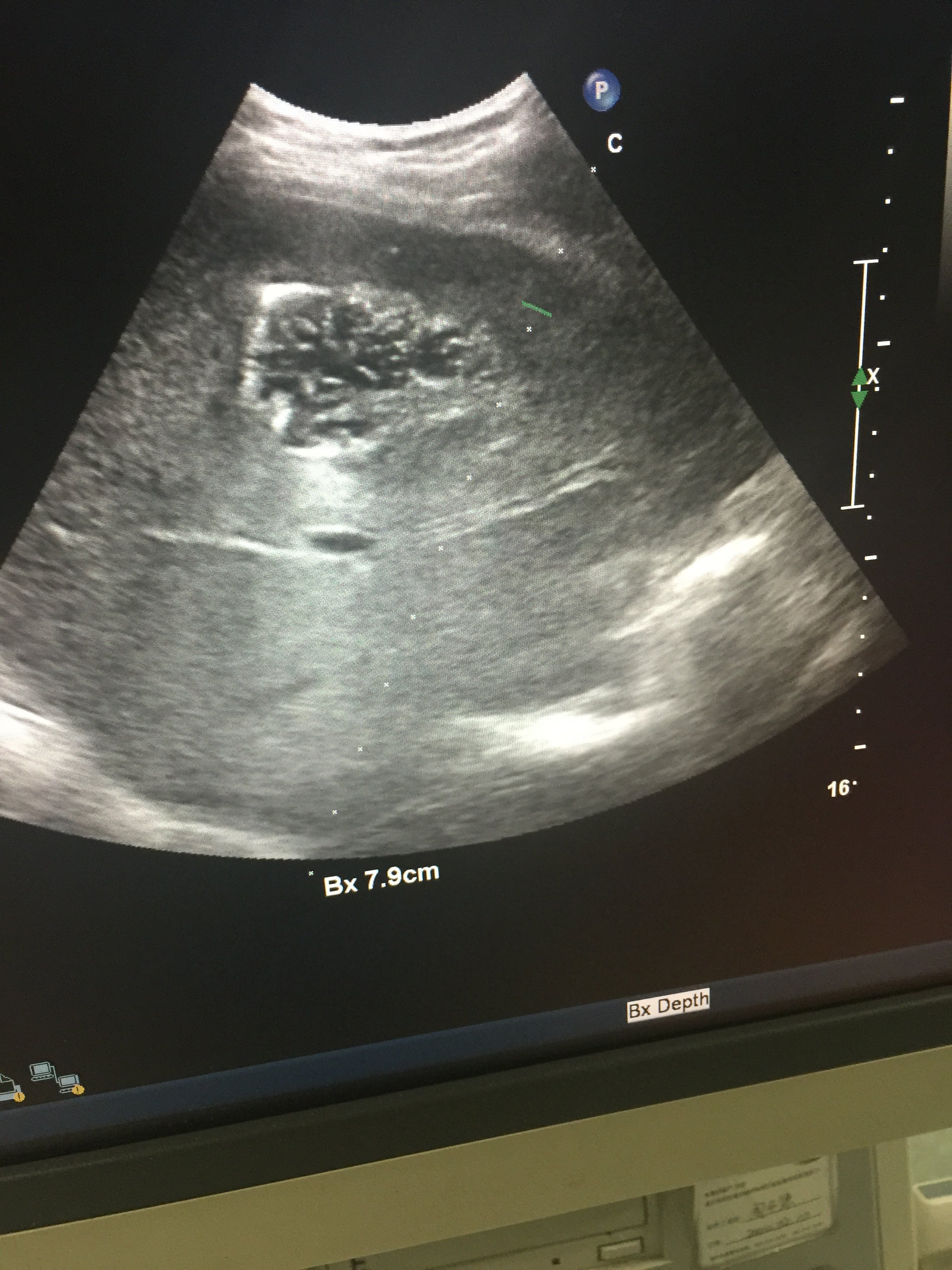 肝脓肿b超引导下穿刺置管引流 - 好大夫在线