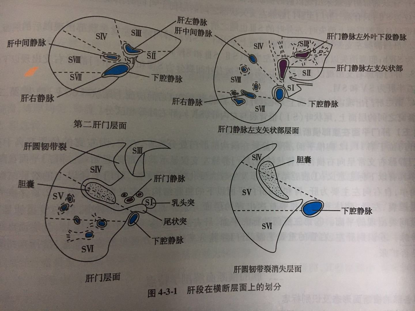 肝脏s4段位置图图片