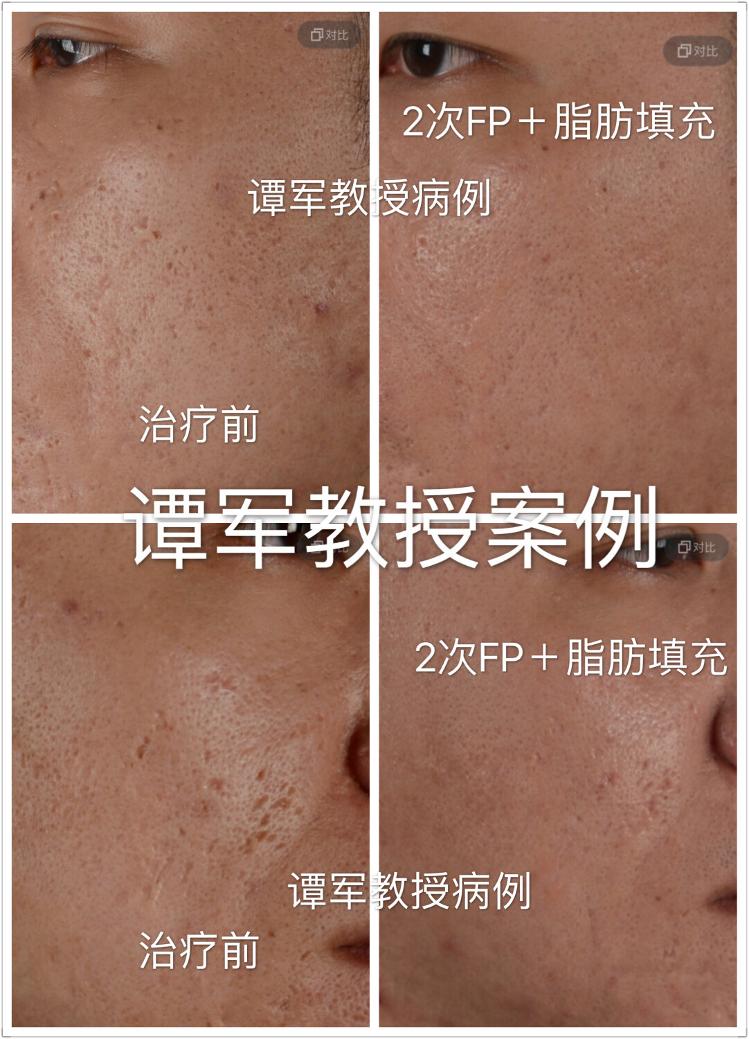 自体脂肪填充治疗重度痤疮凹陷疤痕