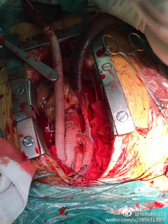 david 全弓 支架象鼻