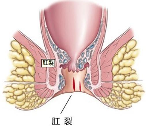 宝宝肛裂引起便血