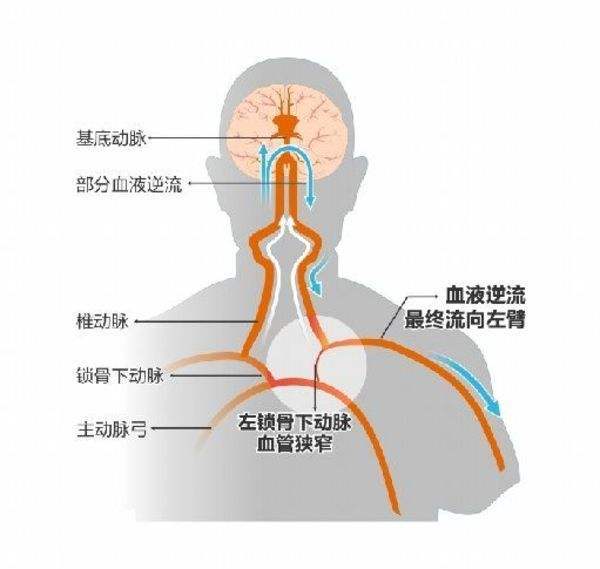 认识锁骨下动脉盗血综合征