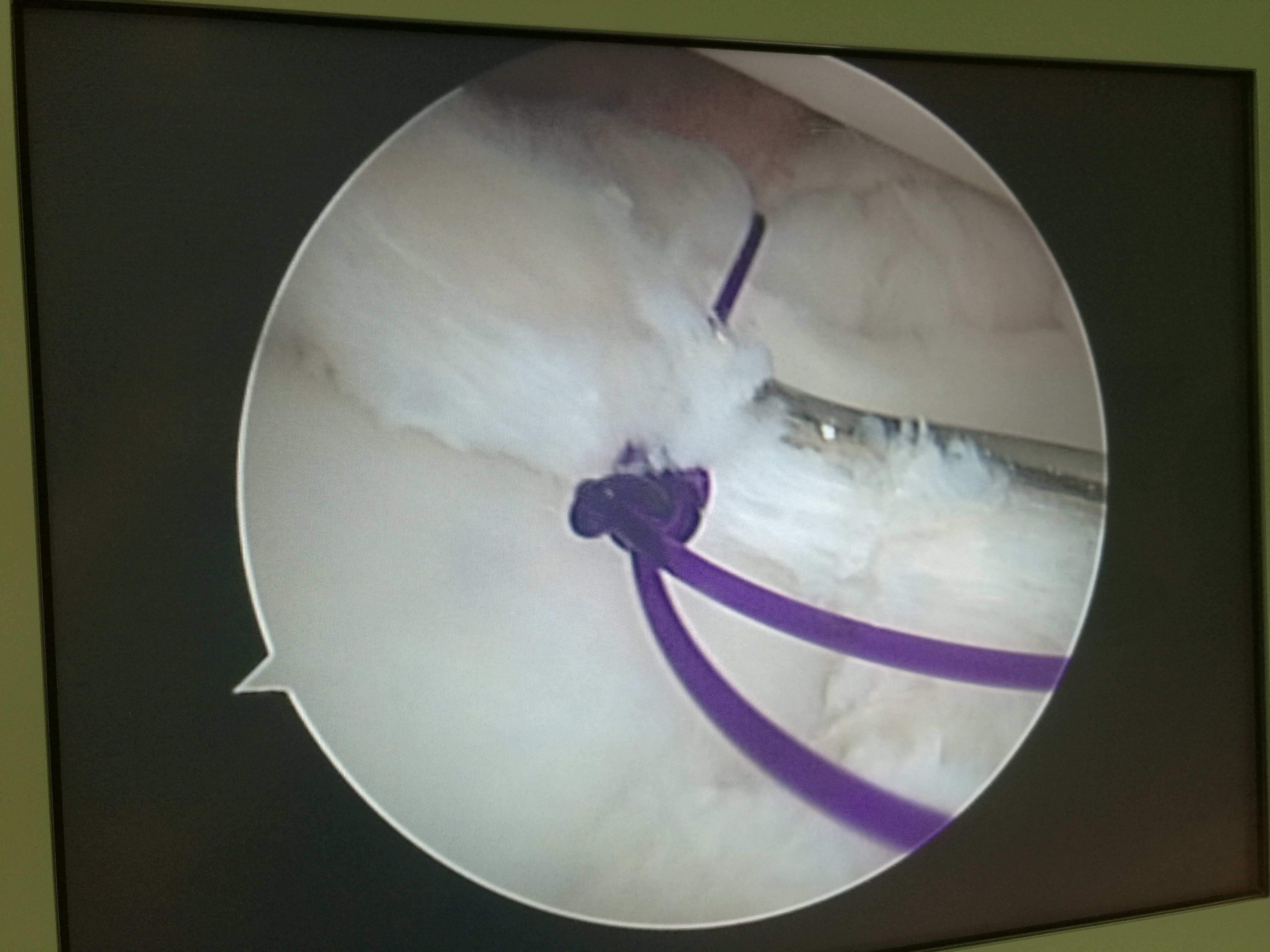 外侧半月板腘肌腱裂孔图片