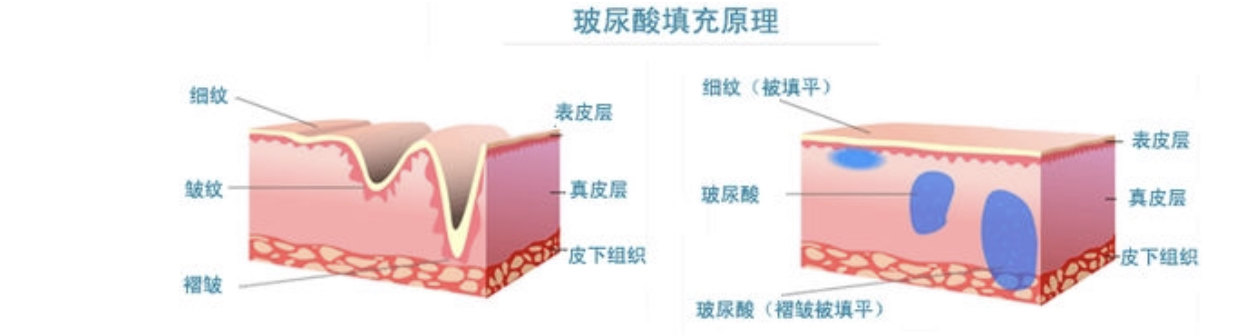 微整形面部年轻化四大神器之二玻尿酸注射 从老佛爷画像谈面部年轻化 五 面部轮廓整形 面部轮廓整形 微整形面部年轻化四大神器之二玻尿酸注射 从老佛爷画像谈面部年轻化 五 面部轮廓整形 面部轮廓整形