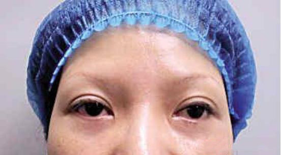 眼袋手术失败凹陷图片图片