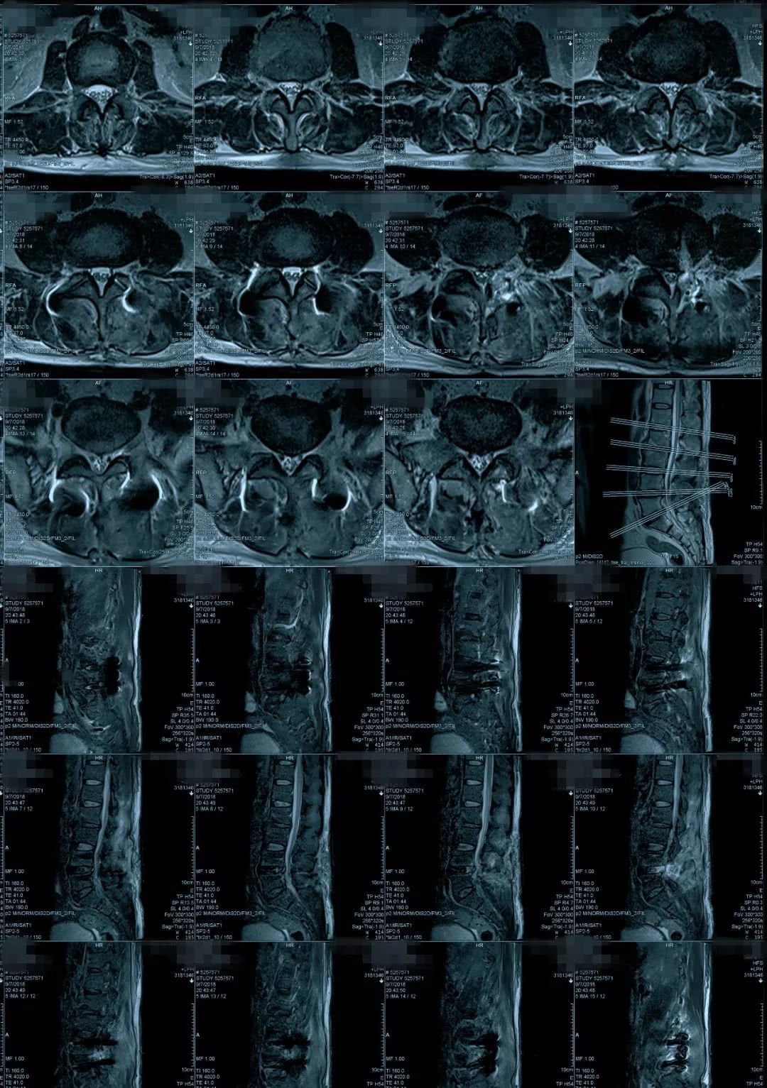 病例点评:腰椎管狭窄 标签: 医学科普 | 作者:李维新 - 好大夫在线