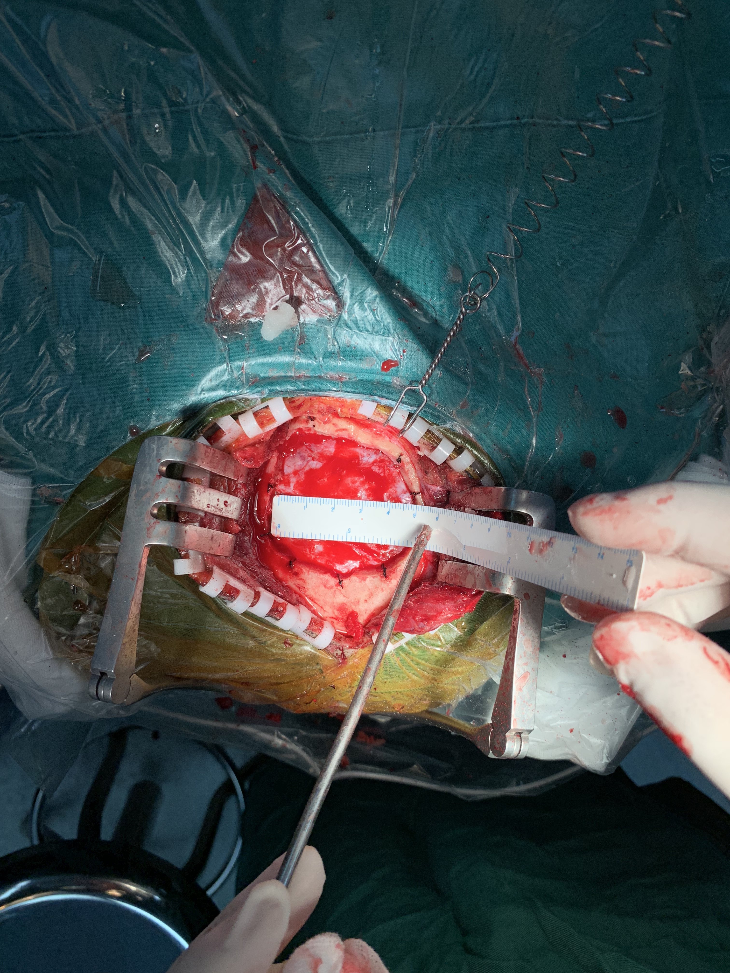 脑干出血的显微手术 - 好大夫在线