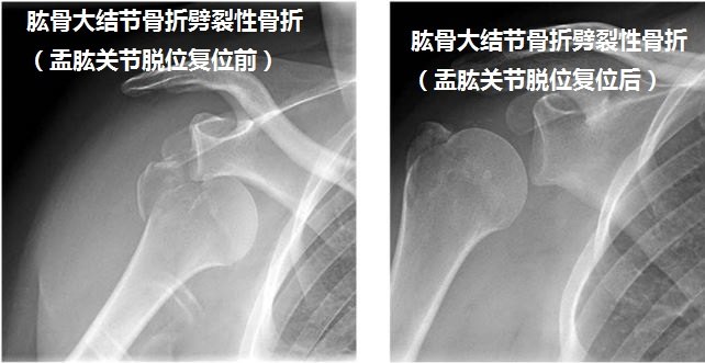 肩關節肱骨大結節骨折分成哪3種類型