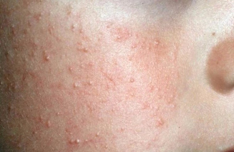 鱼鳞病鸡皮肤治疗(鱼鳞病和鸡皮肤区别图片) 鱼鳞病鸡皮肤治疗(鱼鳞病和鸡皮肤区别图片)