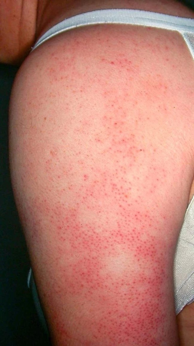 怎样判断鸡皮肤和鱼鳞病(鱼鳞皮肤病和鸡皮肤的区别) 怎样判断鸡皮肤和鱼鳞病(鱼鳞皮肤病和鸡皮肤的区别)