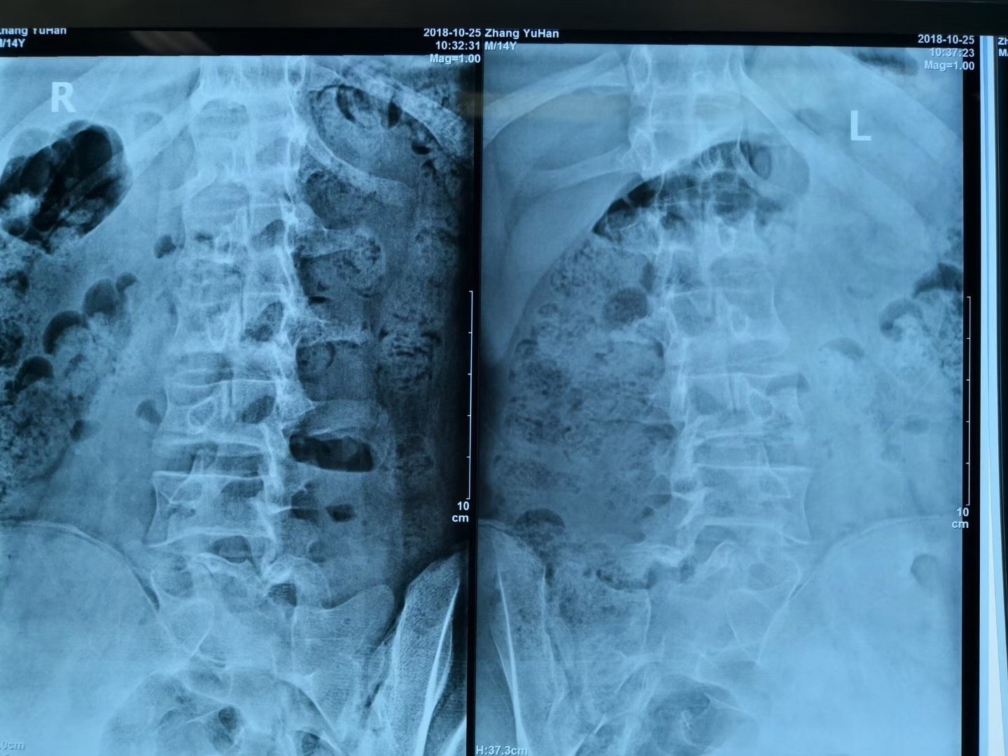 【案例】少年腰椎滑脱症治疗——腰椎疾病不是老年人的专利!