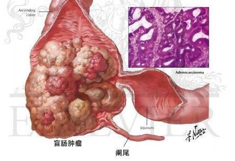 右下腹痛不要想當然是闌尾炎當心盲腸癌